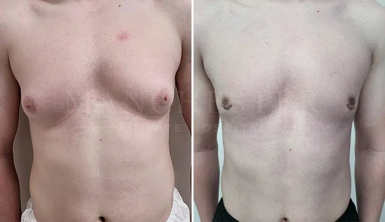 gynecomastia-before-and-after-by-dr-kam-singh-2