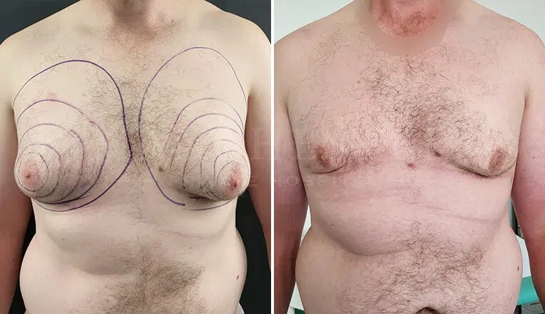 gynecomastia-before-and-after-by-dr-kam-singh-3