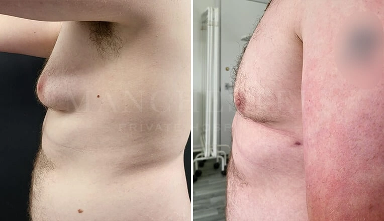 gynecomastia-before-and-after-by-dr-kam-singh-4-1