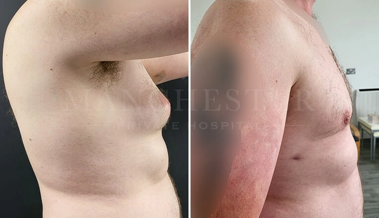 gynecomastia-before-and-after-by-dr-kam-singh-5-1