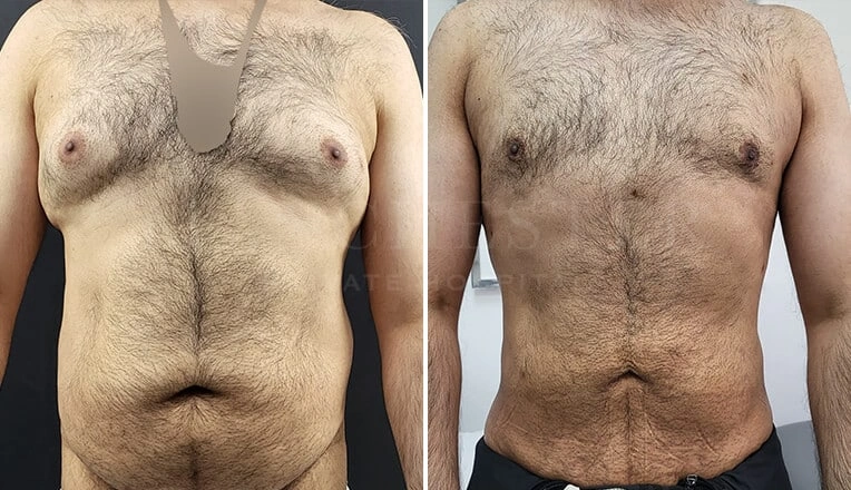 gynecomastia-before-and-after-by-dr-kam-singh-8