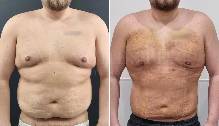 gynecomastia-before-and-after-surgery-by-mr-fiore-10