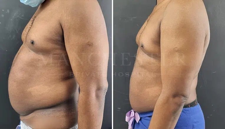 gynecomastia-before-and-after-surgery-by-mr-fiore-4