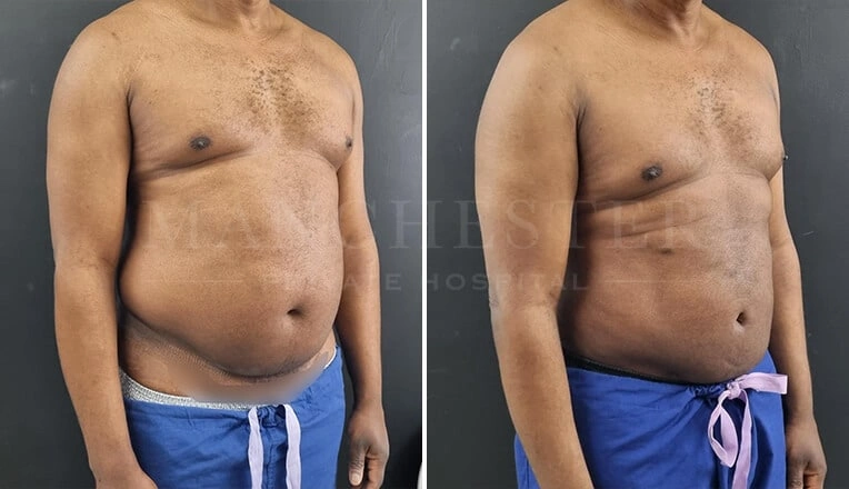gynecomastia-before-and-after-surgery-by-mr-fiore-5