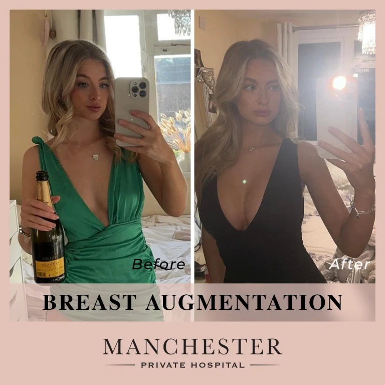 hermione breast enlargement before and after result