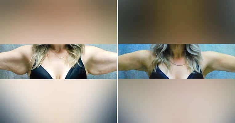 j-plasma-before-and-after-arms-1