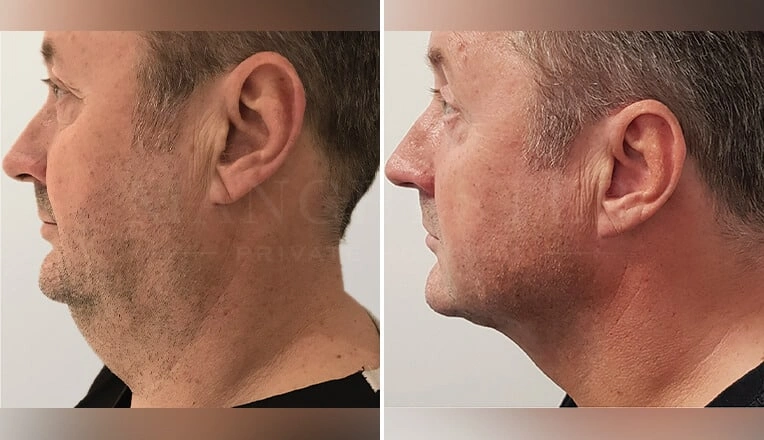 j-plasma-before-and-after-chin