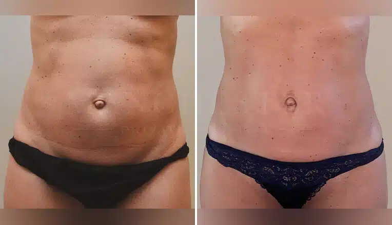 j-plasma-renuvion-before-and-after-1