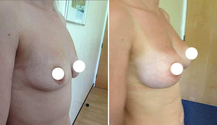 large-breast-lift-before-and-after-1