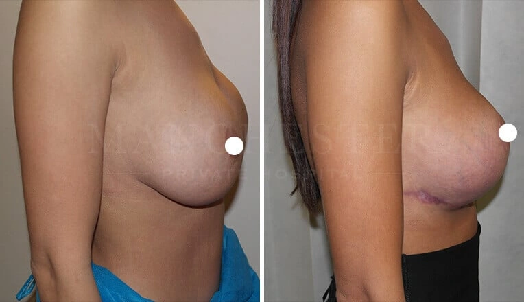 large-breast-lift-before-and-after-3
