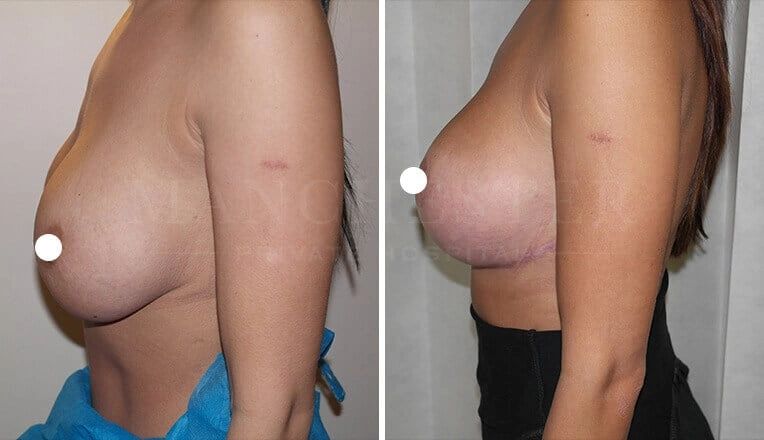 large-breast-lift-before-and-after