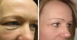 lower-eyelid-blepharoplasty-before-and-after-1