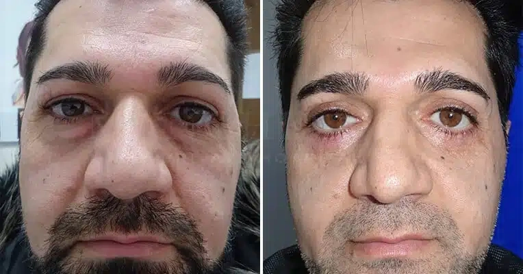 lower-eyelid-blepharoplasty-before-and-after