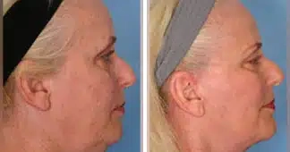 lower-facelift-before-and-after-1