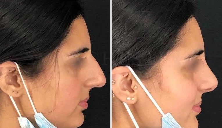 nose-reshaping-before-and-after-1