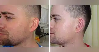 otoplasty-before-and-after-2