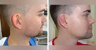 otoplasty-before-and-after