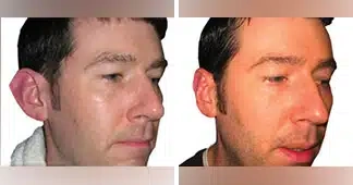 otoplasty-surgery-before-and-after-1