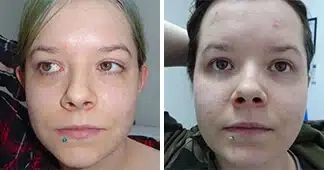 otoplasty-surgery-before-and-after
