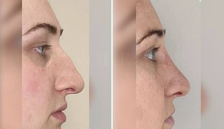 rhinoplasty-before-and-after-2