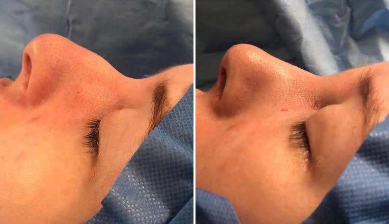 rhinoplasty-before-and-after-photo