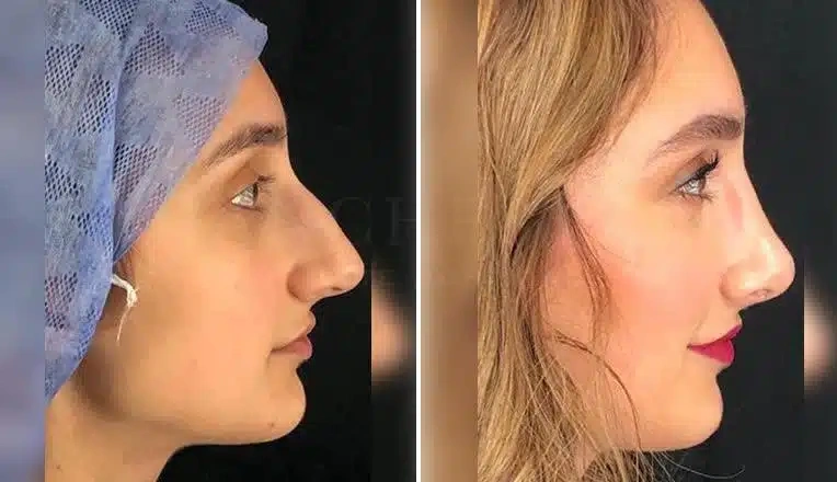 rhinoplasty-before-and-after