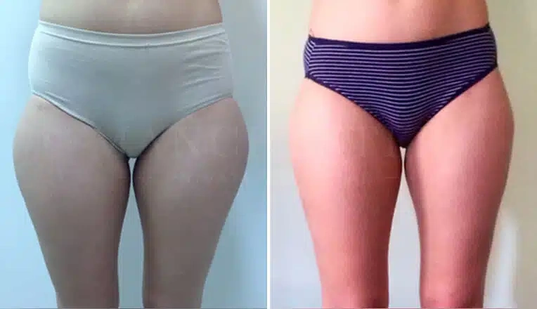 thigh-liposuction-before-and-after-uk-1