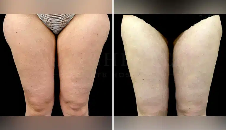 thigh-vaser-liposuction-before-and-after-2