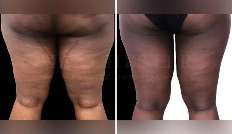 thigh-vaser-liposuction-before-and-after