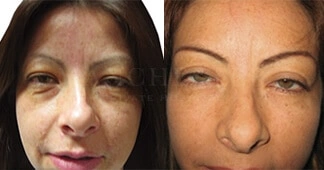under-eye-blepharoplasty-before-and-after-1
