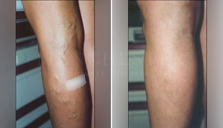 varicose-veins-before-and-after-surgery