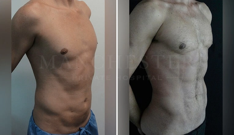 vaser-4d-liposuction-before-and-after