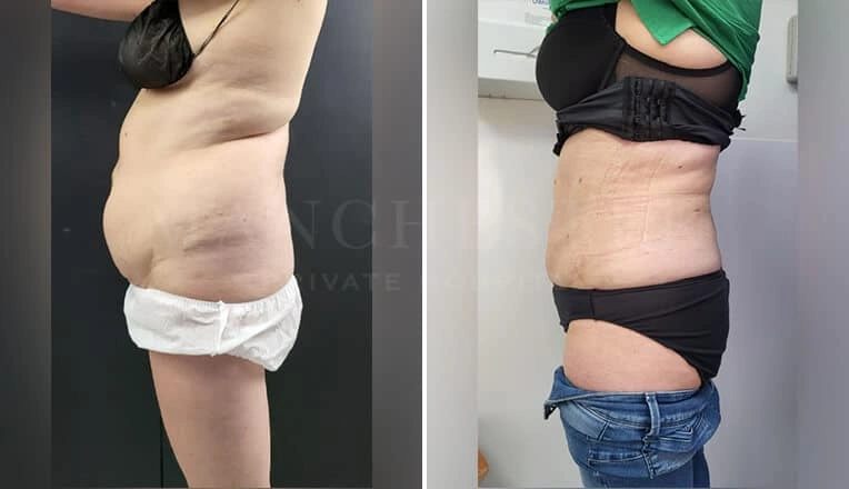 vaser-lipo-before-after-1