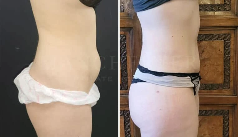 vaser-lipo-before-after