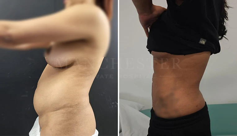 vaser lipo before and after by dr kam singh-4-v2