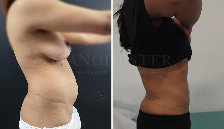vaser lipo before and after by dr kam singh-4-v3