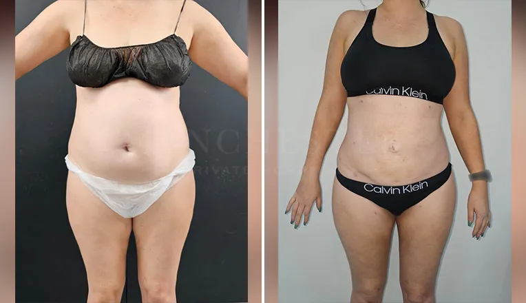 vaser-lipo-before-and-after-stomach-1