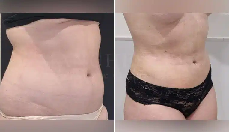 vaser-lipo-before-and-after-stomach-12