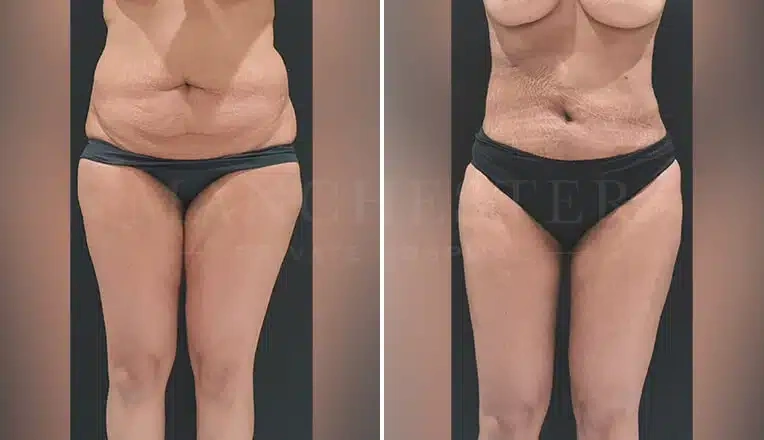 vaser-lipo-before-and-after-stomach-13