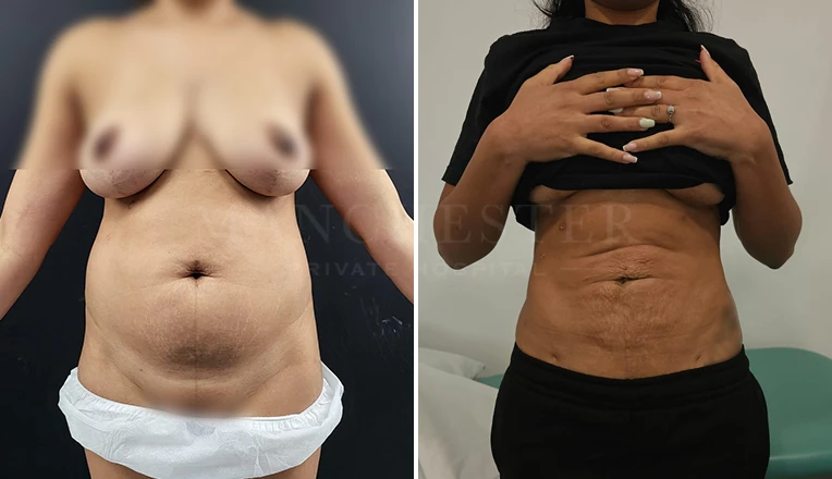 vaser lipo before and after stomach by dr kam singh-4