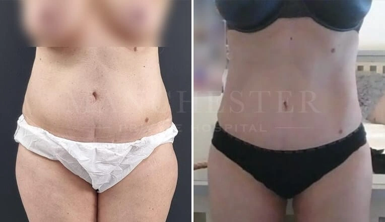 vaser-lipo-before-and-after-stomach-by-mr-fiore-2