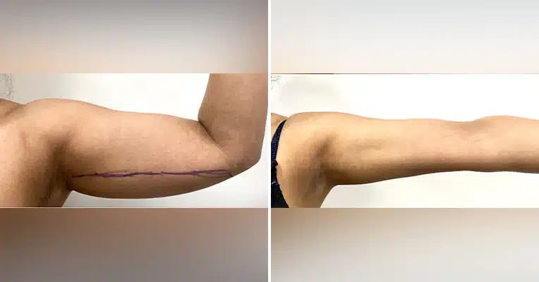 vaser-lipo-on-arms-before-and-after-1