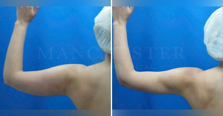 vaser-liposuction-arms-before-and-after-1