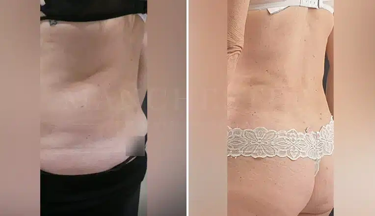 vaser-liposuction-before-and-after-6