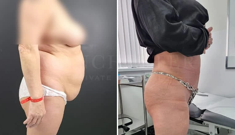 vaser-liposuction-before-and-after-uk-1