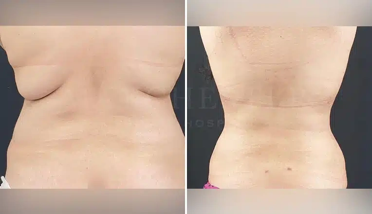 vaser-liposuction-before-and-after-uk-6