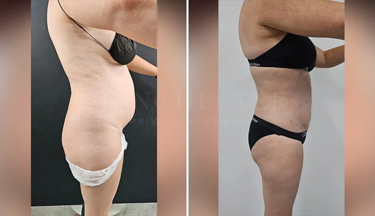 vaser-liposuction-female-abs-before-and-after-1