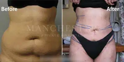 vaser-liposuction-female-abs-before-and-after-2