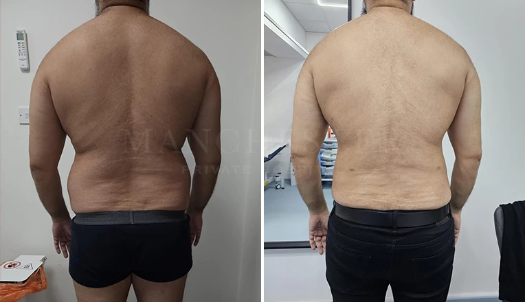 vaser liposuction male before and after patient-8-v1