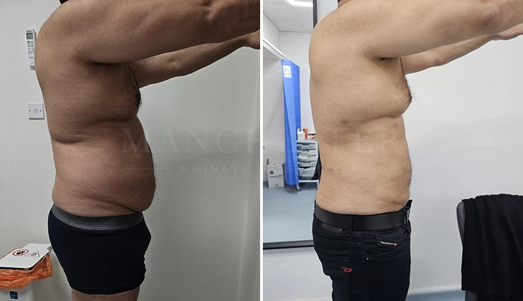 vaser liposuction male before and after patient-8-v2